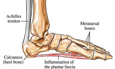 Running into problems: plantar fasciitis, or jogger's heel | Running