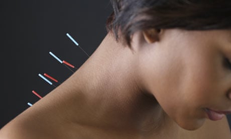Acupuncture needles in a woman's back