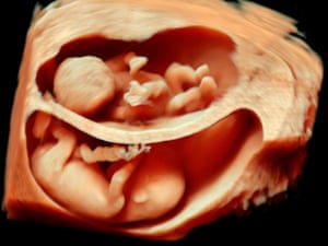 3d Pregnancy Scanning Picture Of The Day Life And Style The