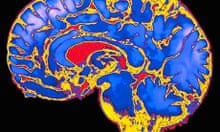case study of phineas gage psychology