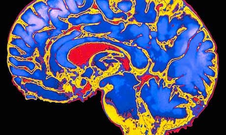 MRI scan of human brain